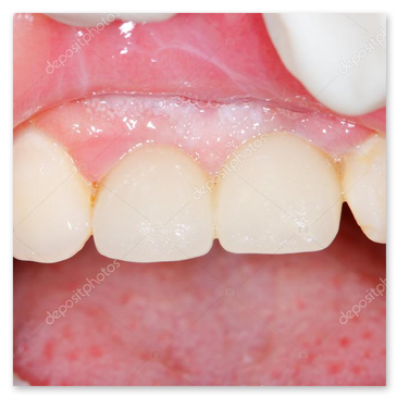 Corona in zirconia multistrato con estetica naturale