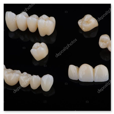 Ponte anteriore in zirconia rifinito
